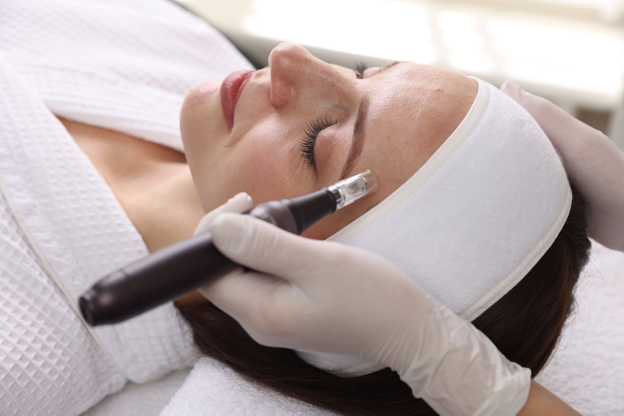 SkinPen Microneedling